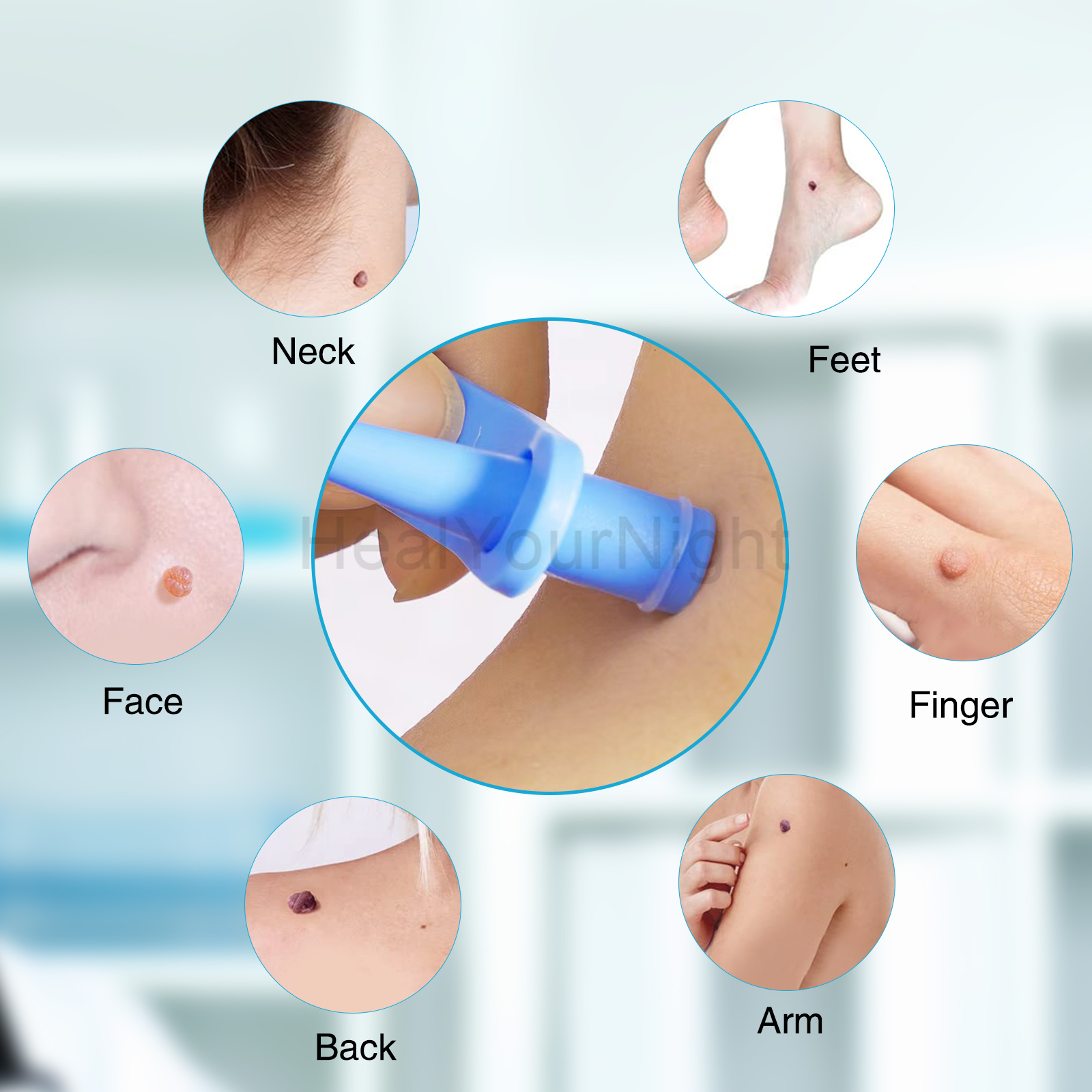 3-IN-1 Auto Skin Tag Removal K - огляд і ціна Acne Light Therapy Pen