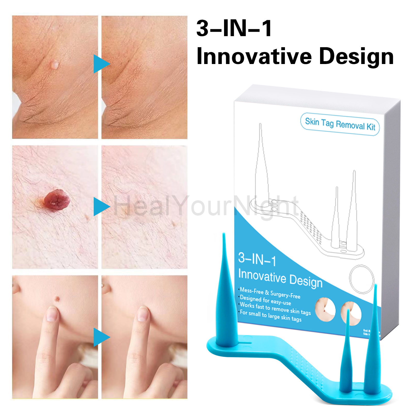 3-IN-1 Auto Skin Tag Removal K - огляд і ціна Acne Light Therapy Pen