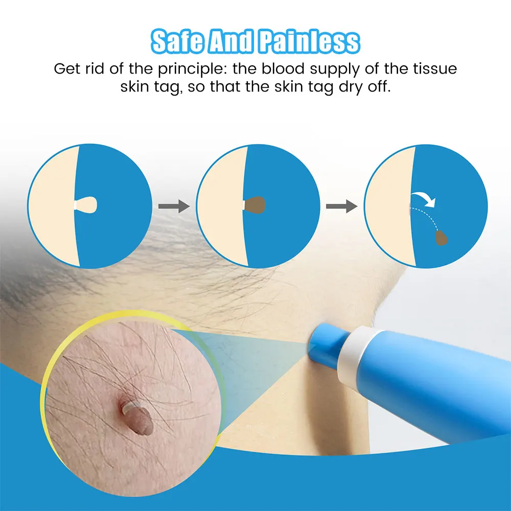 Auto Skin Tag Removal Tool Kit - огляд і ціна Acne Light Therapy Pen
